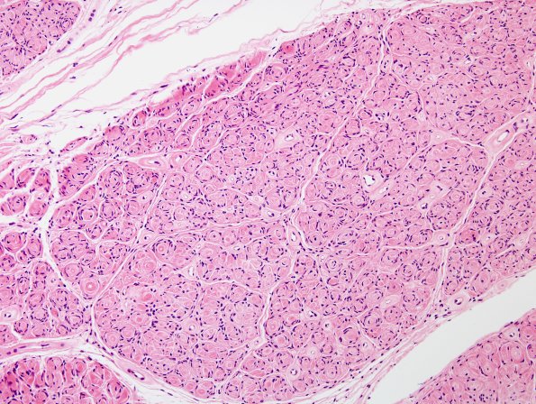 6A2 Perineurioma (Case 6) H&E 2