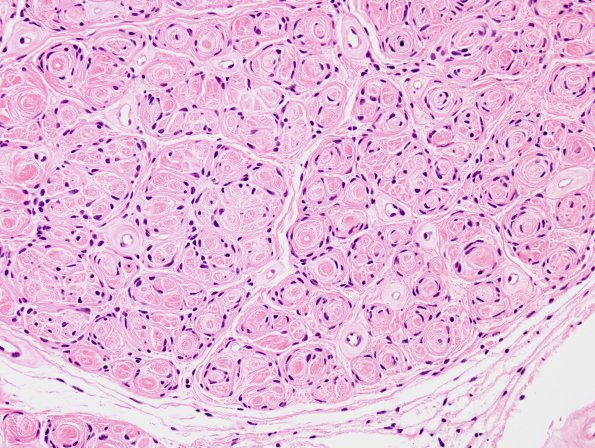 6A3 Perineurioma (Case 6) H&E 1