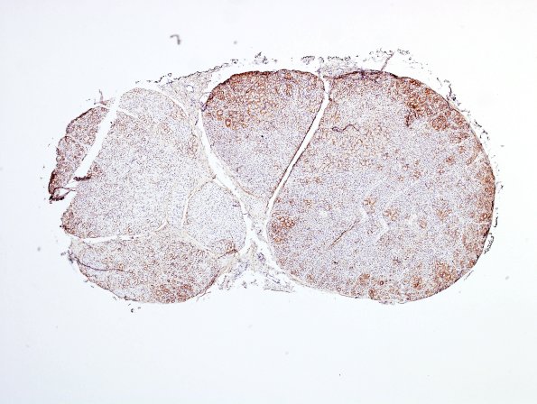 6B1 Perineurioma (Case 6) EMA 5