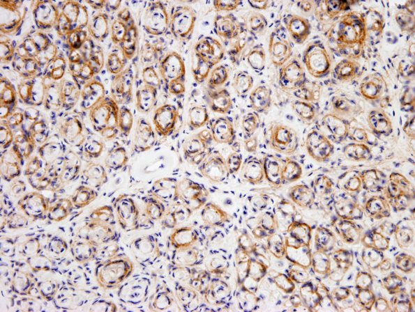 6B2 Perineurioma, intraneural (Case 6) EMA 1.jpg