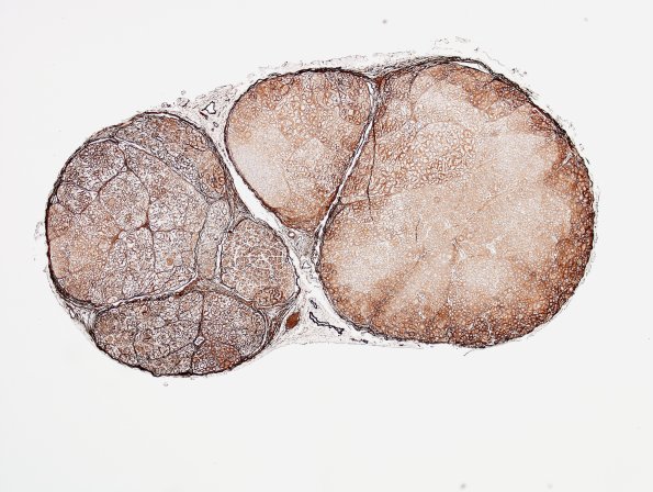 6C1 Perineurioma (Case 6) Coll IV 3