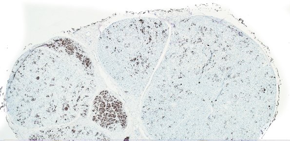 6D1 Perineurioma (Case 6) NF 3