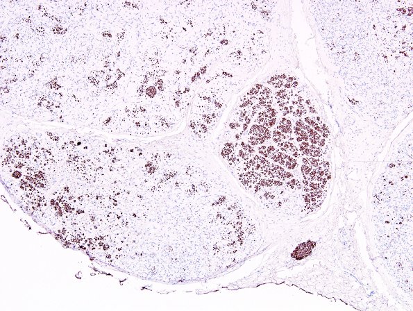 6D2 Perineurioma (Case 6) NF 2