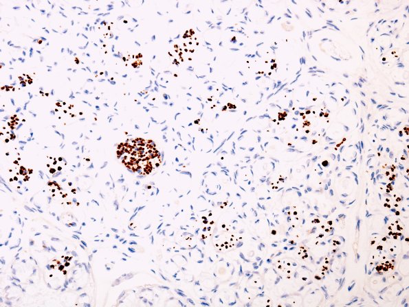 6D3 Perineurioma (Case 6) NF 4