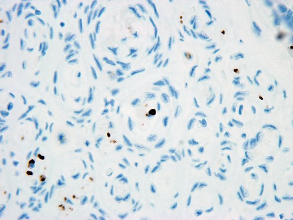 6D4 Perineurioma, intraneural (Case 6) NF 7.jpg