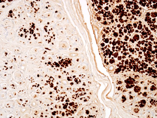 6E2 Perineurioma (Case 6) S100 1