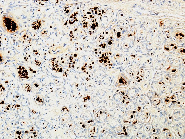 6E3 Perineurioma (Case 6) S100 5