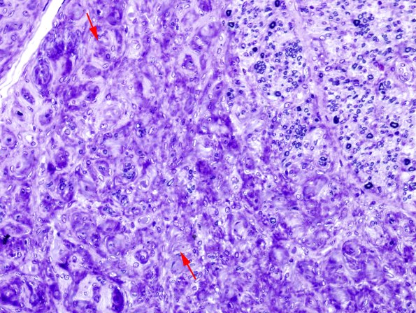 6G1 Perineurioma (Case 6) Plastic 8 copy