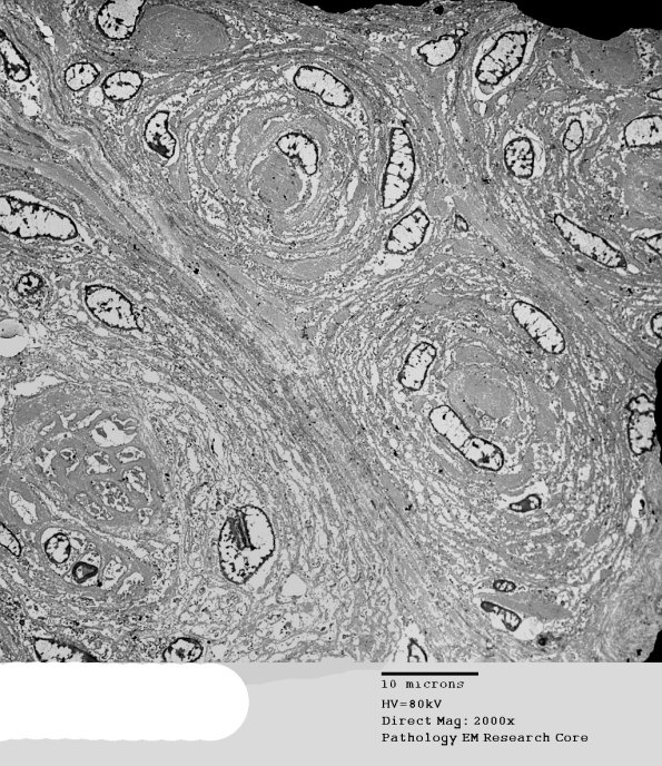 6H1 Perineurioma (Case 6) 022 - Copy