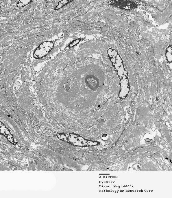 6H2 Perineurioma (Case 6) 016 - Copy