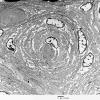 6H3 Perineurioma (Case 6) 023 - Copy