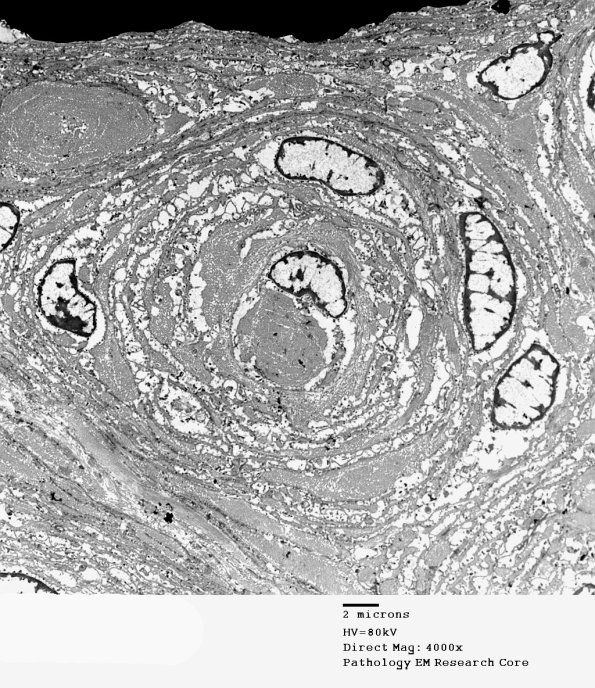 6H3 Perineurioma (Case 6) 023 - Copy