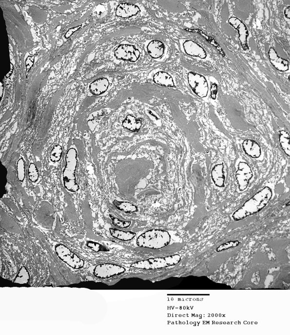 6H4 Perineurioma (Case 6)  EM 6 - Copy