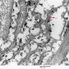 6H5 Perineurioma (Case 6) 026 copy - Copy