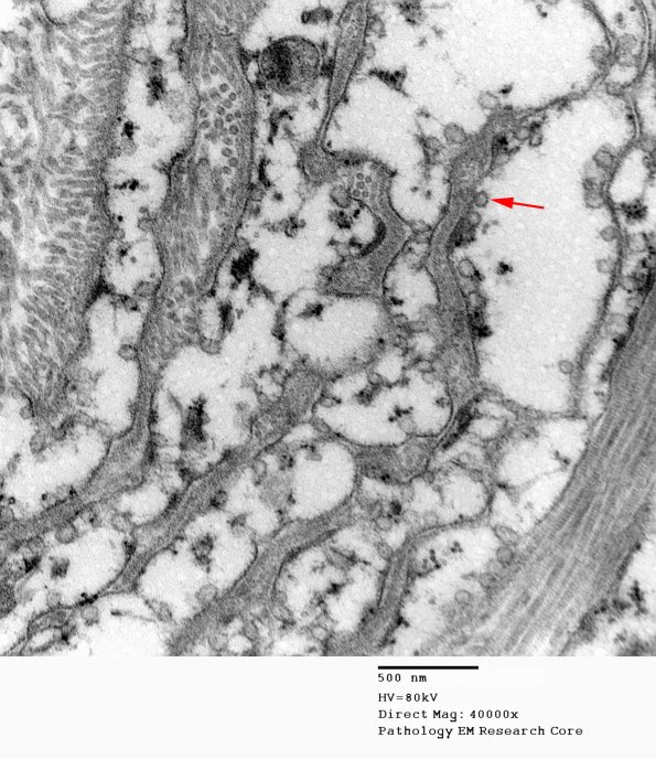 6H5 Perineurioma (Case 6) 026 copy - Copy