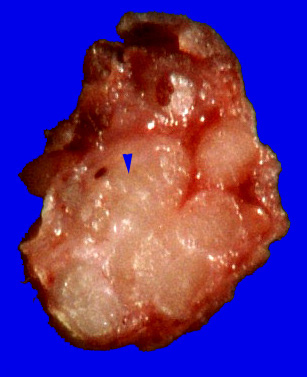 7A2 Perineurioma (Case 7) 6a