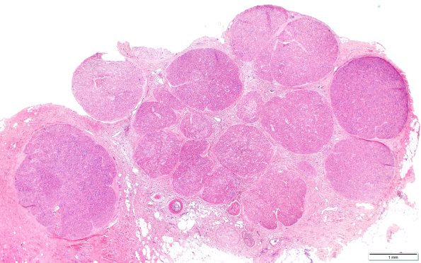 7B1 Perineurioma (Case 7) H&E B (scale)