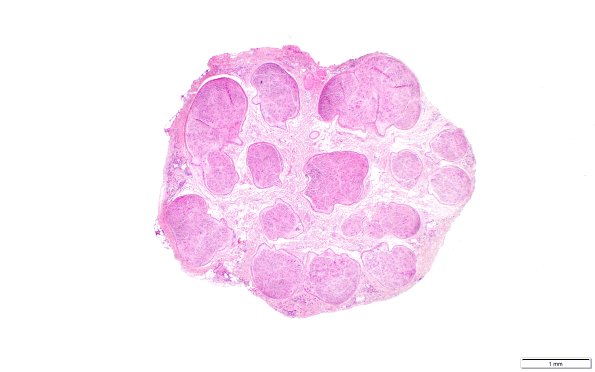 7B2 Perineurioma (Case 7) H&E B (scale) 2