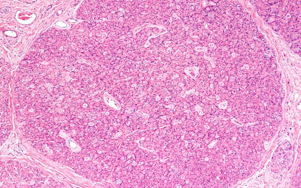 7B3 Perineurioma (Case 7) H&E B 10X