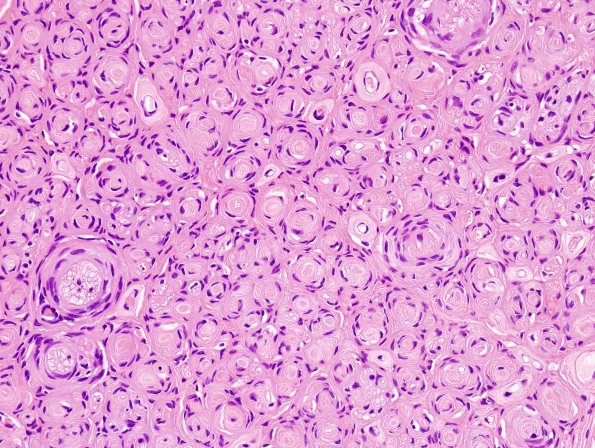 7B4 Perineurioma (Case 7) H&E 6