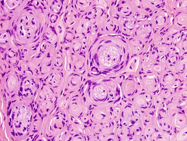 7B5 Perineurioma (Case 7) H&E 13