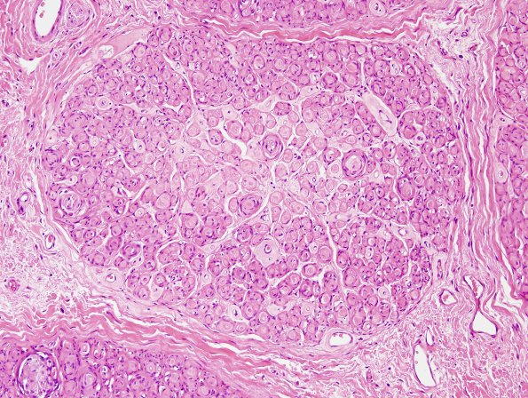 7B6 Perineurioma (Case 7) H&E 4