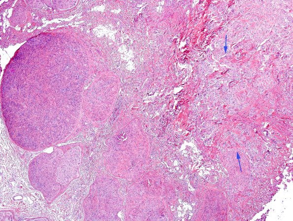 7C1 Perineurioma (Case 7) H&E neuroma area 2 copy