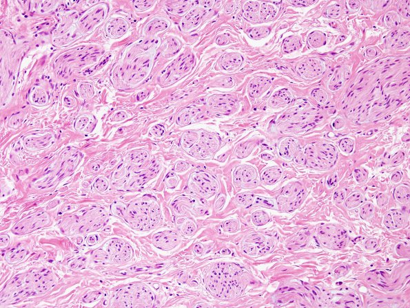 7C2 Perineurioma (Case 7) H&E neuroma area 4