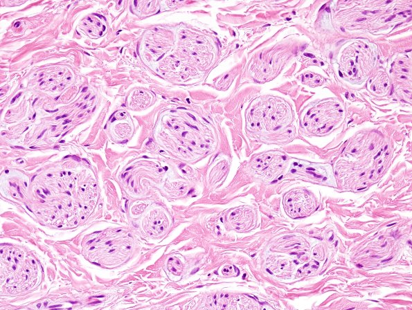 7C3 Perineurioma (Case 7) H&E neuroma area 5