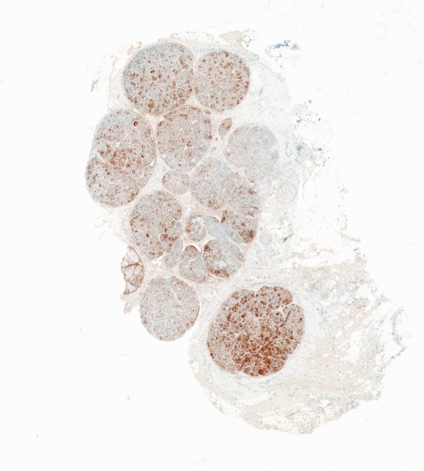 7D1 Perineurioma (Case 7) EMA main tumor WM