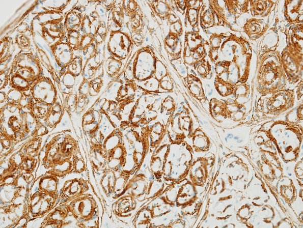 7D3 Perineurioma (Case 7) EMA 6