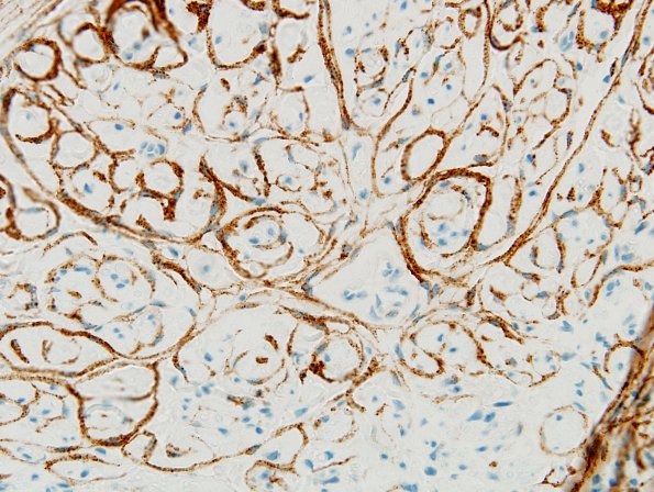 7D4 Perineurioma (Case 7) EMA 9