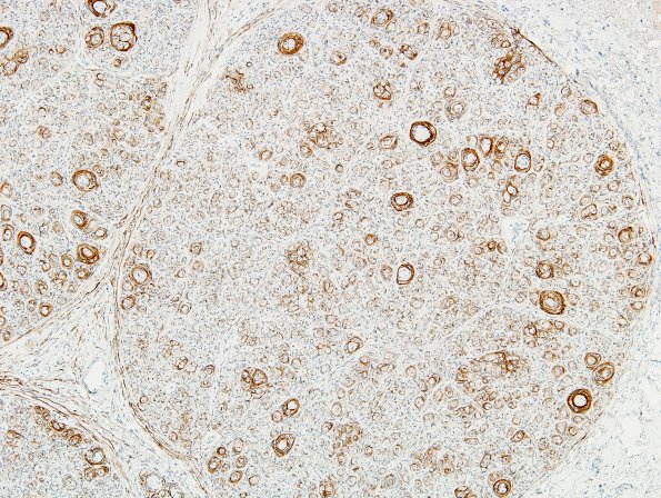 7D6 Perineurioma (Case 7) EMA 13