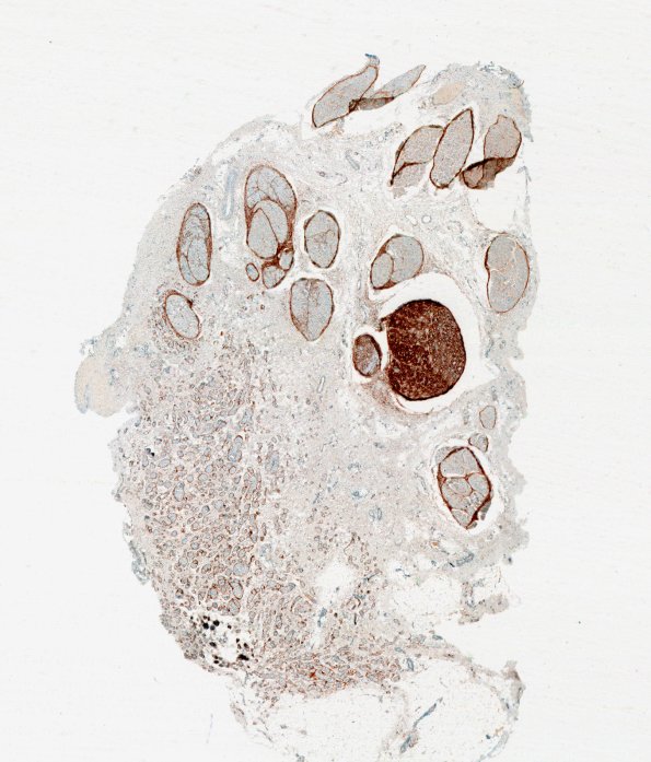 7E1 Perineurioma (Case 7) EMA neuroma area