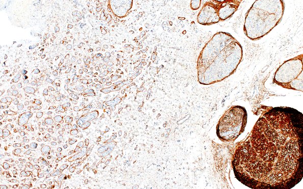 7E2 Perineurioma (Case 7) EMA neuroma area 4X