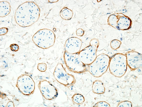 7E3 Perineurioma (Case 7) EMA 3