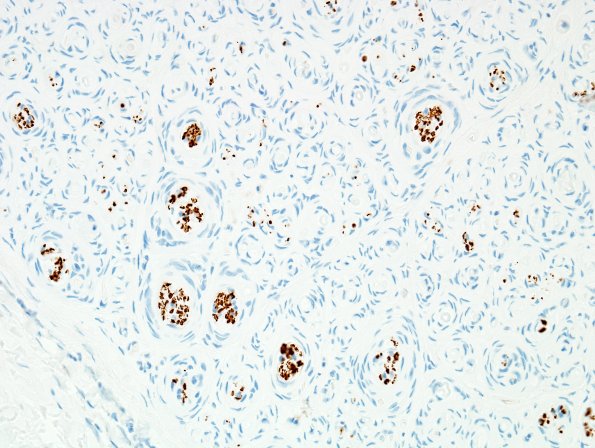 7F2 Perineurioma (Case 7) NF 9