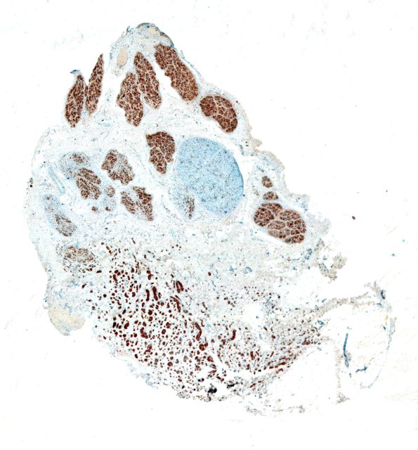 7G1 Perineurioma (Case 7) NF neuroma area