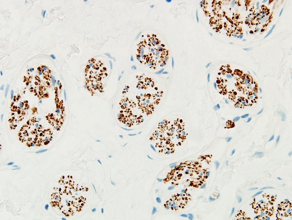 7G2 Perineurioma (Case 7) NF neuroma area 15