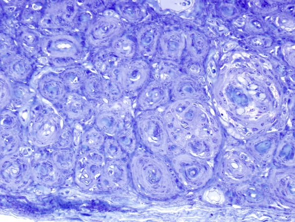 7H2 Perineurioma (Case 7) Plastic 3