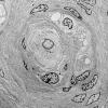 7I1 Perineurioma (Case 7) EM 007 - Copy