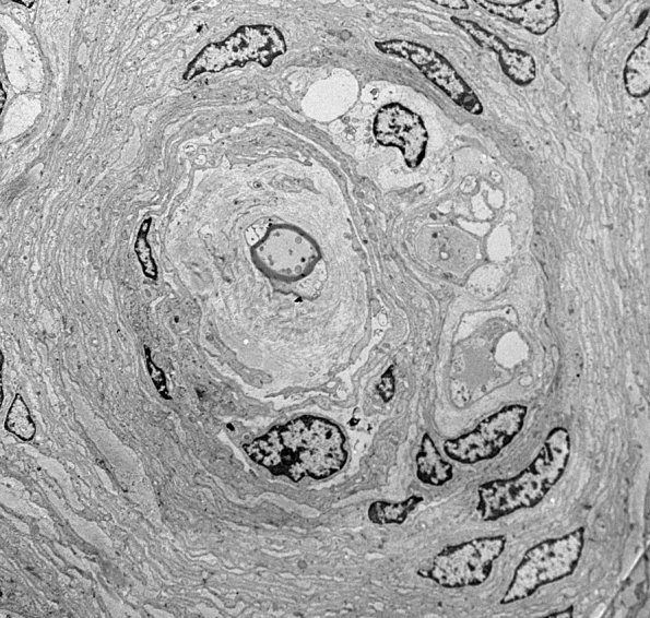 7I1 Perineurioma (Case 7) EM 007 - Copy