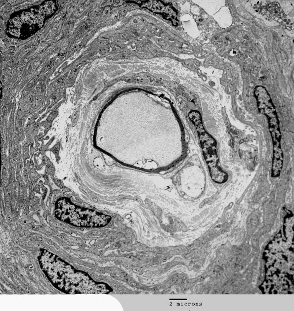 7I2 Perineurioma (Case 7) EM 25a - Copy