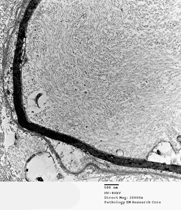 7I3 Perineurioma (Case 7) EM 22a - Copy