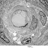 7I4 Perineurioma (Case 7) EM 020 - Copy (2)