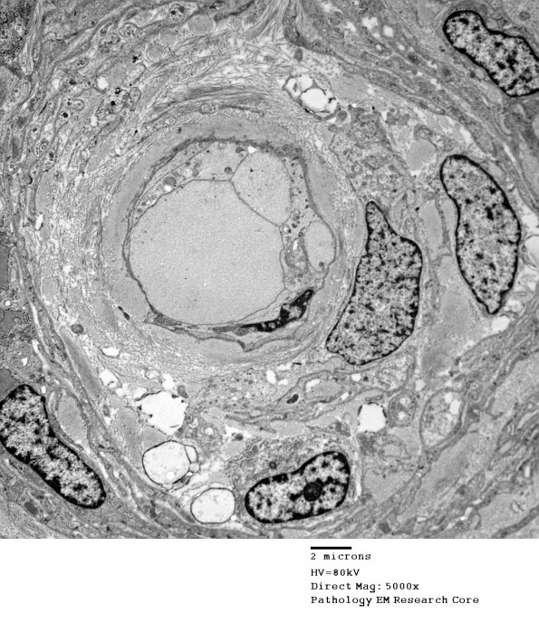 7I4 Perineurioma (Case 7) EM 020 - Copy (2)