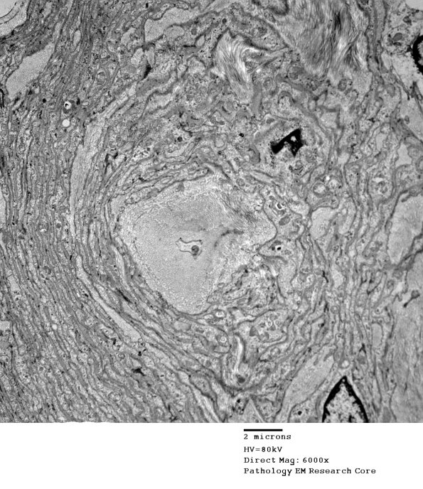 7I5 Perineurioma (Case 7) EM 033 - Copy (2)