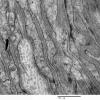 7I6 Perineurioma (Case 7) EM 036 - Copy