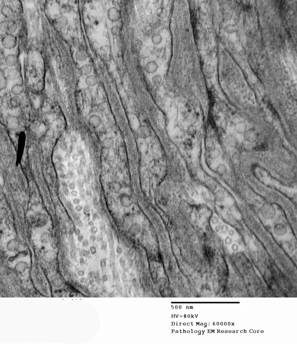 7I6 Perineurioma (Case 7) EM 036 - Copy