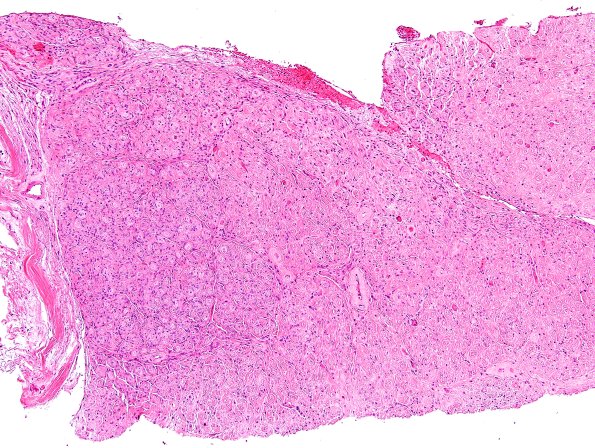 8A1 Perineurioma (Case 8) H&E 4.jpg